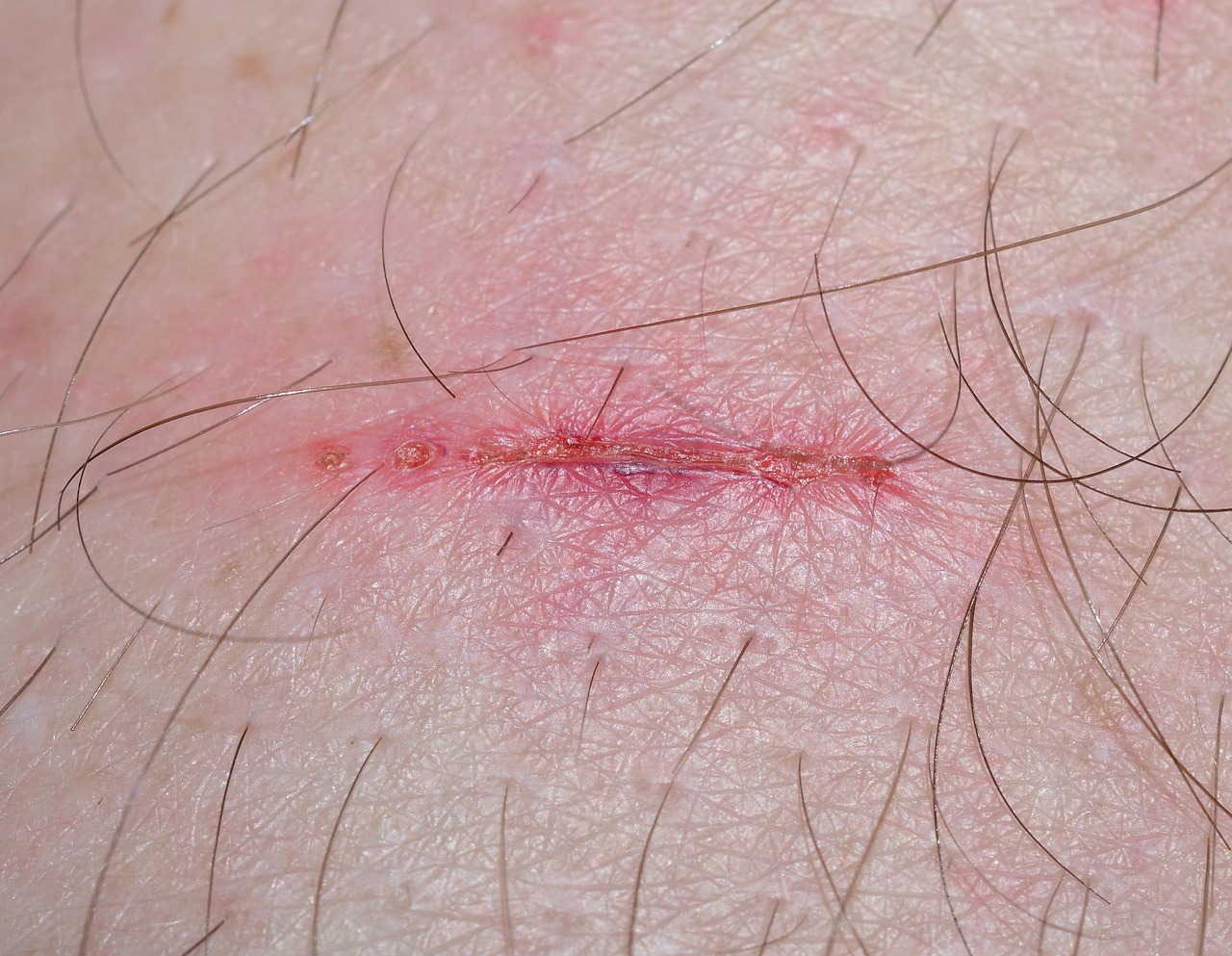 Nutritional Considerations in Wound Healing