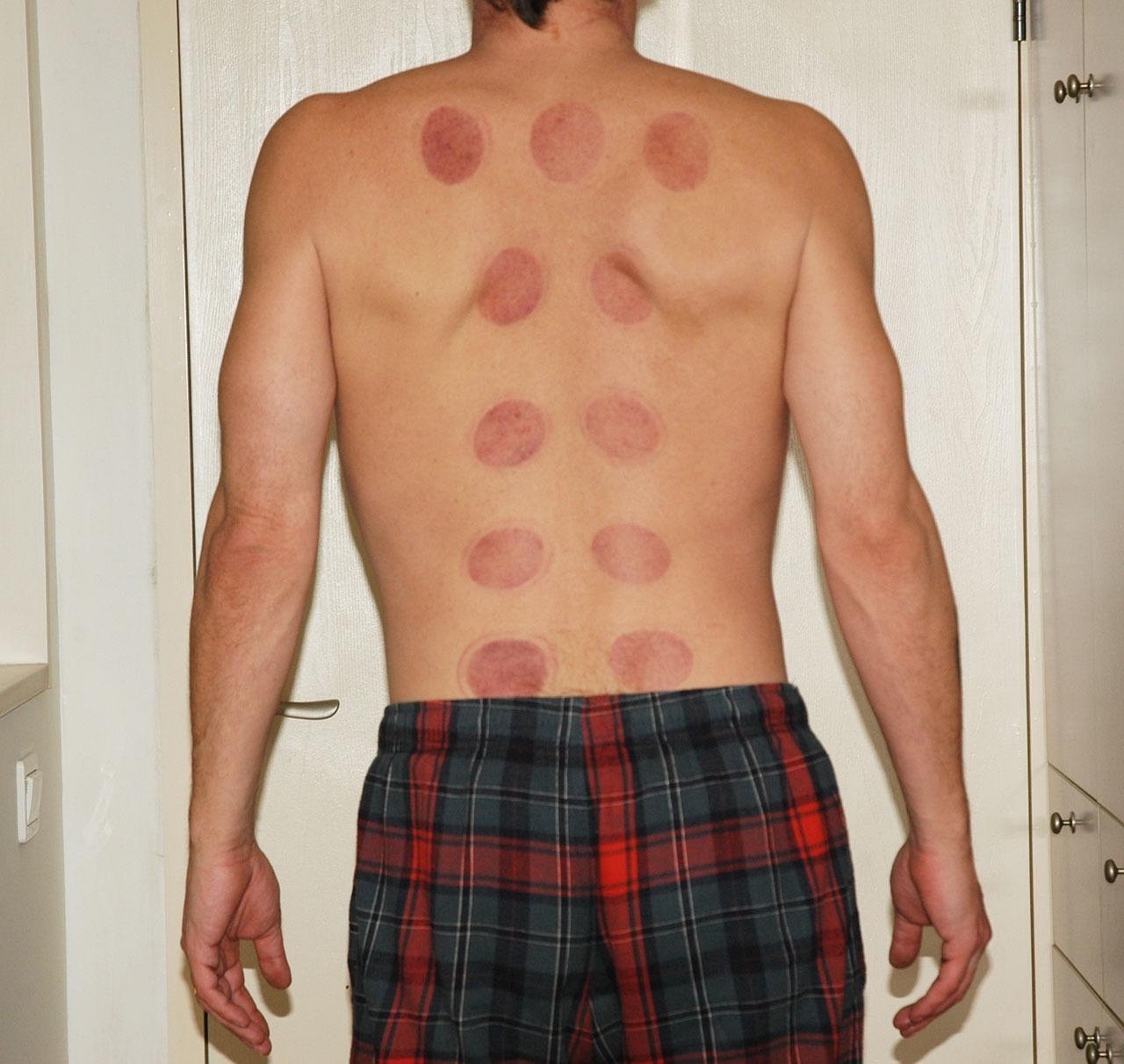 Acupuncture Treatment Planning