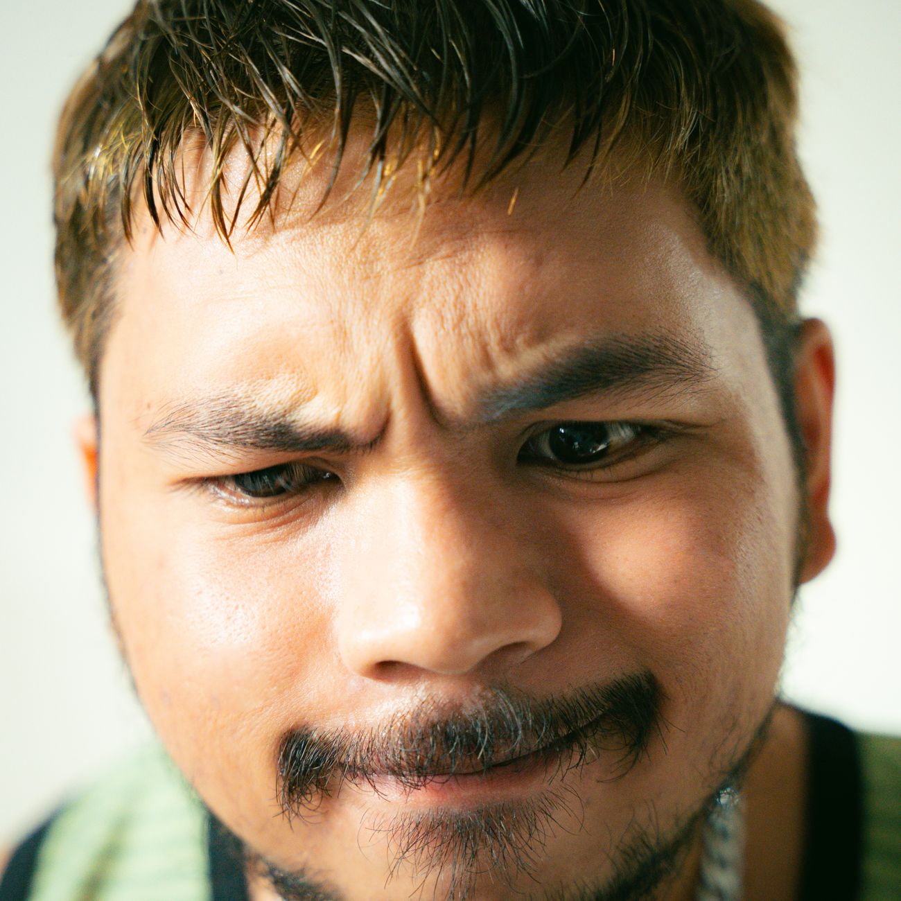 Hair Transplant Surgery